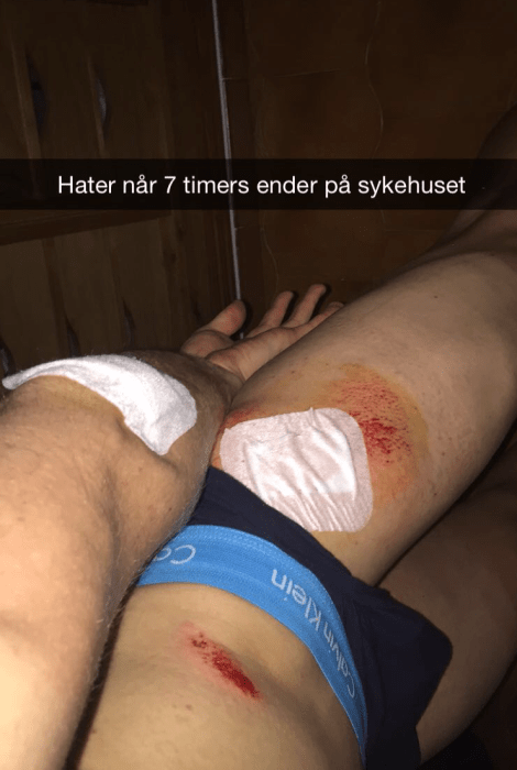 Slik ser en forslått sykkelkropp ut dagen etter velt, det å dusje blir en mindre behagelig opplevelse samt at sengetøyet ser ut som en slagmark fult av blod.