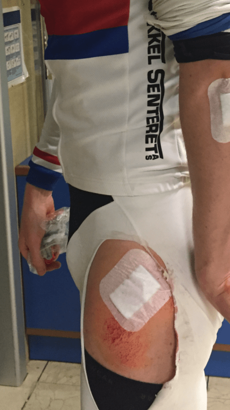 Uansett hvordan, når og hvor det skjer er velt på sykkel uansett vondt.